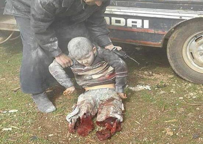 فيديو مؤلم جدا.. طفل سوري بترت قدماه يصيح ''يا بابا شيلني''