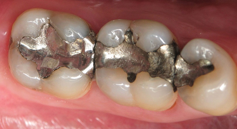 خطير: 42% من أطباء الأسنان يتخلصون من نفايات الزئبق بمطارح الأزبال