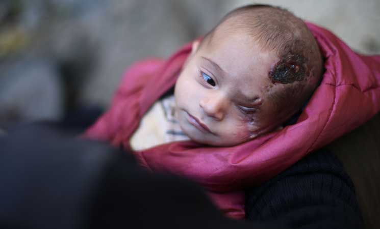 الرضيع "كريم" السوري.. حكاية نزوح ويتم وإصابة خطيرة في شهره الأول (قصة إنسانية)