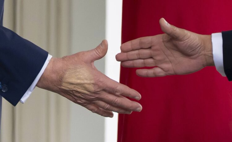 صور كدمات في يد الرئيس الأميركي دونالد ترامب تثير الجدل والبيت الأبيض يوضح السبب