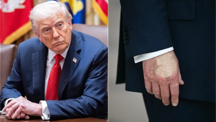 الرئيس الأميركي دونالد ترامب يوضح سبب الكدمات على يده وينفي الشائعات الصحية